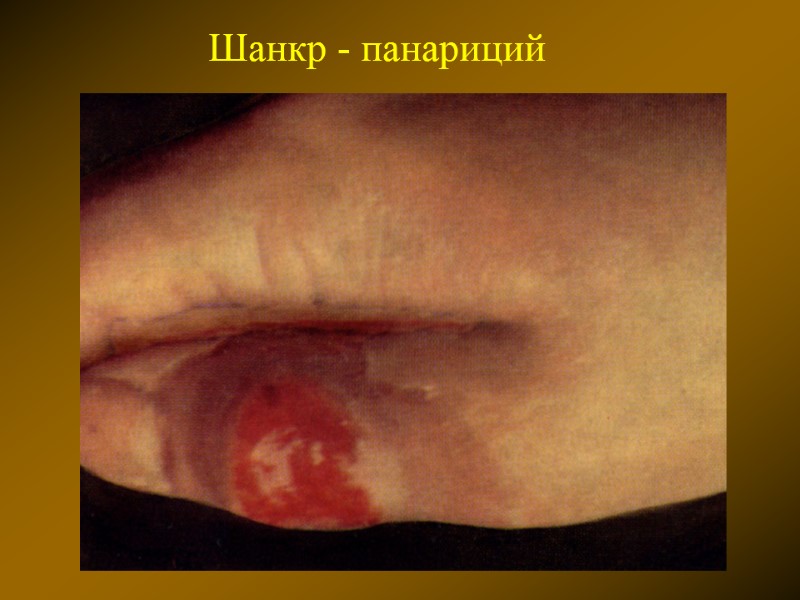 Шанкр - панариций